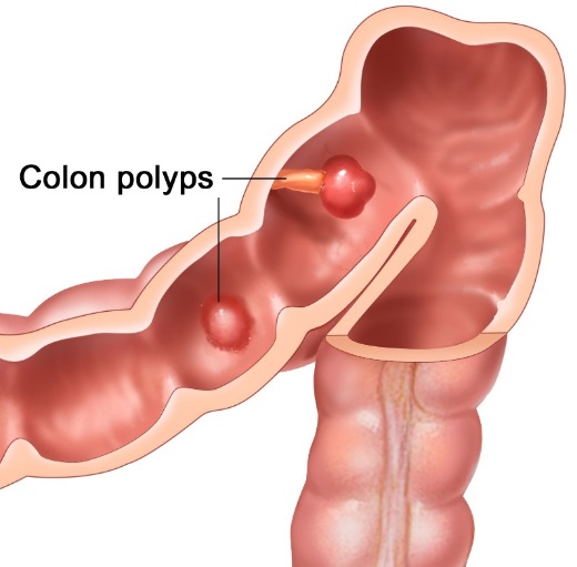 Illustration showing two types of polyps in the Colon